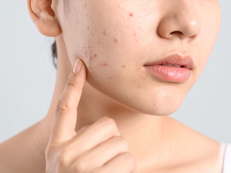 sabonete de glicerina é bom para espinhas